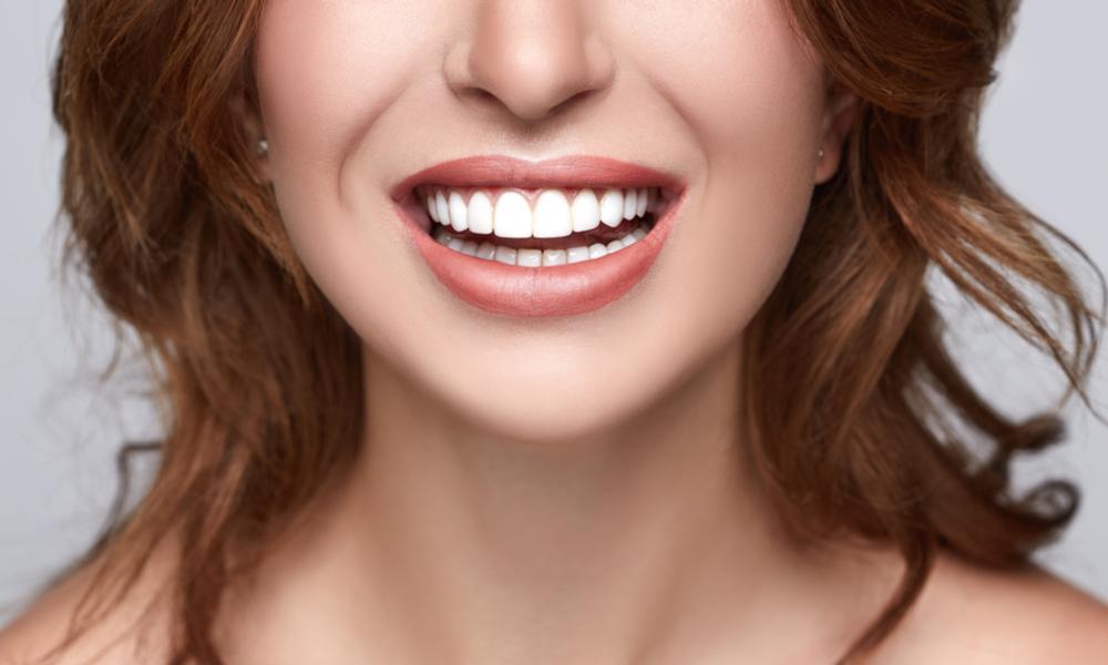 Cosa sono le faccette dentali
